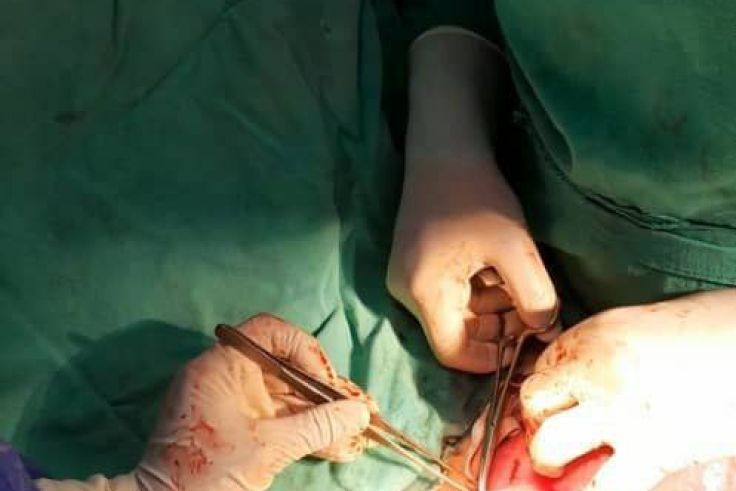 حالة تمزق رحم نادرة أثناء الولادة الطبيعية